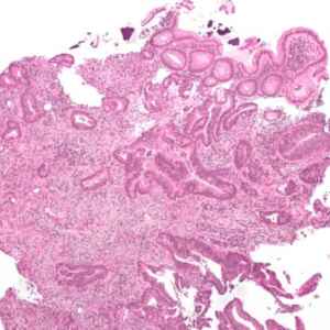 Inteligência Artificial na Luta Contra o Câncer Colorretal