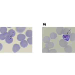 A Inteligência Artificial na Luta Contra a Malária
