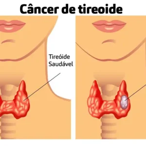Incidência de Câncer de Tireoide e Acessibilidade de Exames Câncer de tireoide