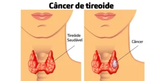 Câncer de tireoide