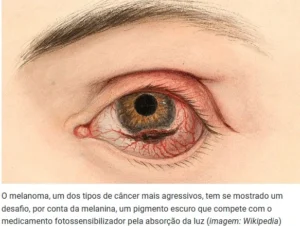 melanoma e fotodinâmica