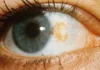 Método com Fotodinâmica para Erradicar o Melanoma Ocular melanoma ocular
