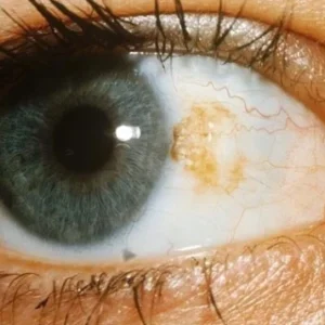 Método com Fotodinâmica para Erradicar o Melanoma Ocular melanoma ocular