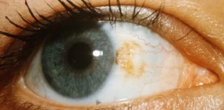 melanoma ocular