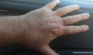 Captura-de-tela-2024-06-07-105021-300x179 Estudo da Fiocruz Reduz Riscos no Tratamento da Leishmaniose Cutânea