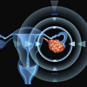 Novo exame de sangue detecta câncer de ovário anos antes dos métodos convencionais