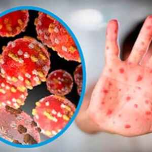 Tudo o que você precisa saber sobre o surto de mpox surto