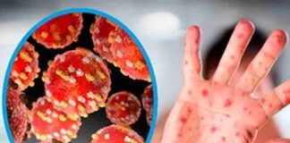 Tudo o que você precisa saber sobre o surto de mpox surto