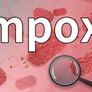 Suécia relata 1º caso de mpox mais letal fora da África Suecia