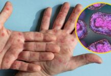 Entendendo a Mpox: Informações da OPAS mpox