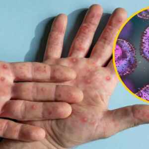 Entendendo a Mpox: Informações da OPAS mpox