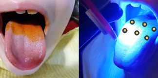 No estudo, o fotossensibilizador usado foi o urucum, combinado com luz LED azul