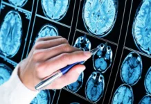 Inteligência artificial revoluciona diagnóstico de epilepsia grave ao detectar lesões cerebrais invisíveis epilepsia