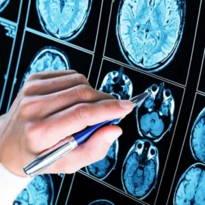 Inteligência artificial revoluciona diagnóstico de epilepsia grave ao detectar lesões cerebrais invisíveis epilepsia