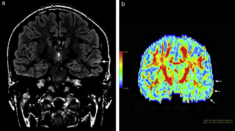 tese_fisica2-1536x870-1-1 Inteligência artificial revoluciona diagnóstico de epilepsia grave ao detectar lesões cerebrais invisíveis