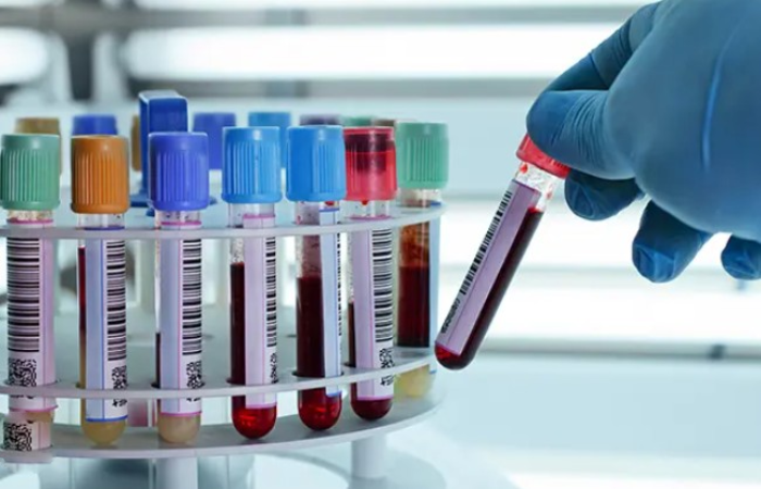 Novo exame de sangue detecta Parkinson antes dos primeiros sintomas 3 Parkinson