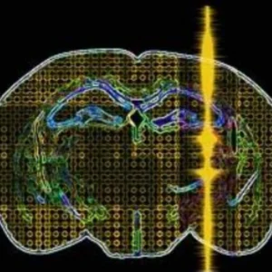 Estudos inéditos avançam no uso de ultrassom focalizado no tratamento do Parkinson tecnologia