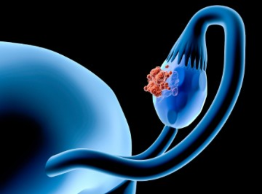 Ovário contaminado por microplásticos acende alerta sobre fertilidade feminina 2 Screenshot 2025 04 22 172018