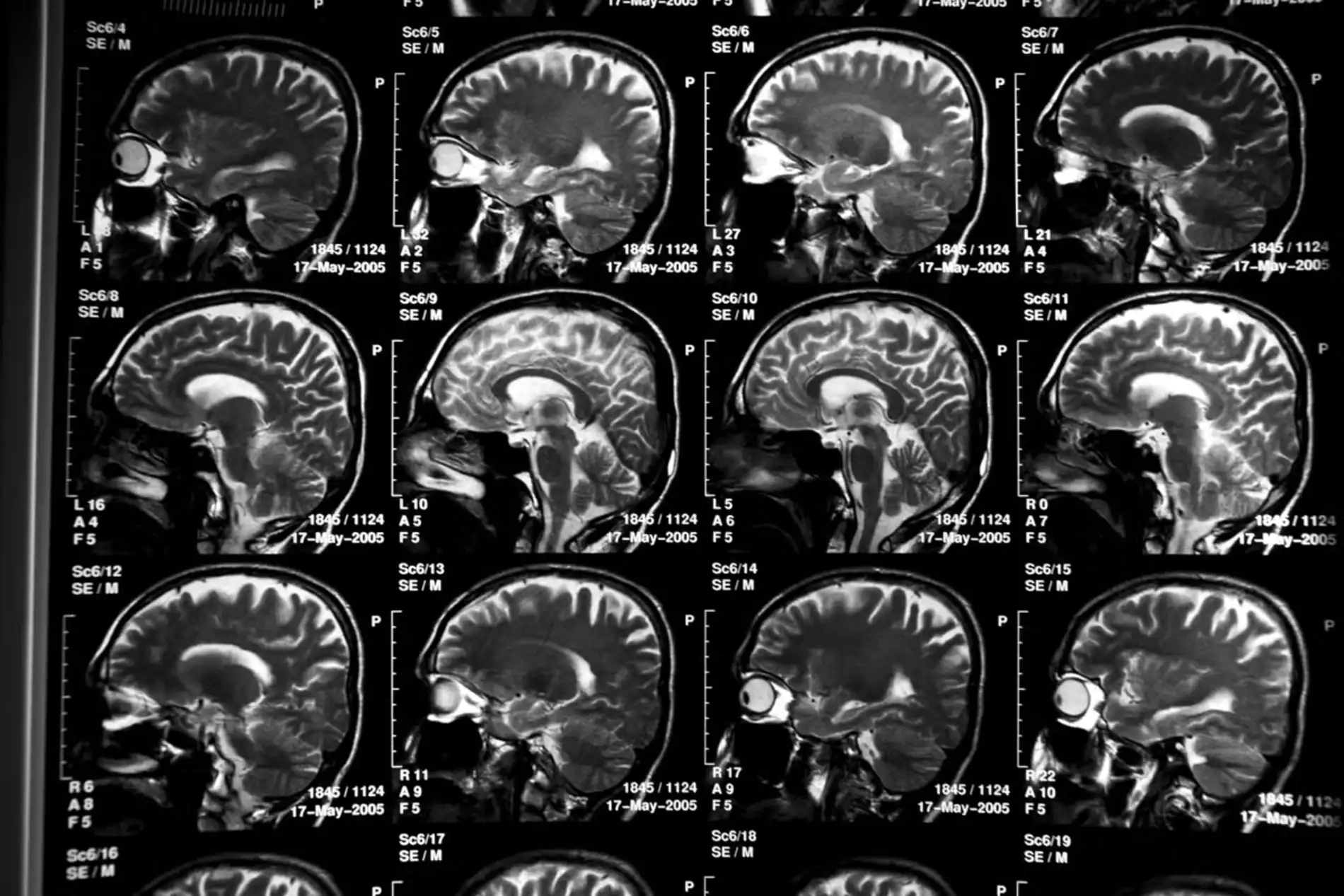 alzheimers-trial-prevention-7 Kisunla revoluciona tratamento de Alzheimer no Brasil