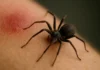 5 sinais de picada de aranha que exigem atenção imediata 5 sinais de picada de aranha que exigem atenção imediata
