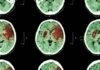 AVC quase dobrou entre adultos de 20 a 54 anos em três décadas, e os cientistas ainda não sabem explicar por quê AVC quase dobrou entre adultos de 20 a 54 anos em três décadas, e os cientistas ainda não sabem explicar por quê