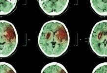 AVC quase dobrou entre adultos de 20 a 54 anos em três décadas, e os cientistas ainda não sabem explicar por quê AVC quase dobrou entre adultos de 20 a 54 anos em três décadas, e os cientistas ainda não sabem explicar por quê