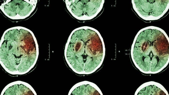 AVC quase dobrou entre adultos de 20 a 54 anos em três décadas, e os cientistas ainda não sabem explicar por quê AVC quase dobrou entre adultos de 20 a 54 anos em três décadas, e os cientistas ainda não sabem explicar por quê