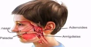 Captura-de-tela-2024-05-14-124703-300x155 Amígdalas e Adenoides Podem abrigar SARS-CoV-2 em Crianças