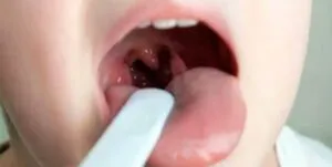 Captura-de-tela-2024-05-14-124928-300x151 Amígdalas e Adenoides Podem abrigar SARS-CoV-2 em Crianças