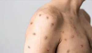 Captura-de-tela-2024-08-19-182844-300x174 Tudo o que você precisa saber sobre o surto de mpox